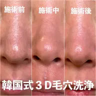 【圧倒的結果の出る毛穴洗浄】韓国式3D毛穴洗浄モニター募集