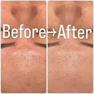 ✨肌質激変✨REVIハーブピーリングで陶器肌へ🌿お肌の悩みを根本から解決します♪[心斎橋/メンズ］