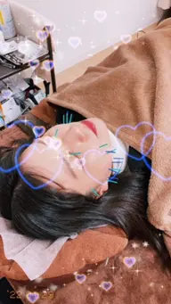 ✨おススメ【新規限定】🌸美容鍼＋ヘッドマッサージ