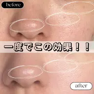 プラズマしみケア 15分 当て放題