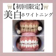 【美歯セルフホワイトニング】3回（15分）セットが4,980円
