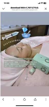 WIQO水光ピーリーング&マイケロニードルの相乗効果でニキビ、肌質改善しクリアな素肌へ✨