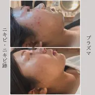 【ニキビケア】水光プラズマ／ニキビの素のアクネ菌を殺菌！赤ニキビ、凸凹肌、肌荒れ、くすみなど、あらゆる肌悩みに◎