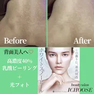 【🌹人に見せたくなる背中へ♡🌻】背中全体スペシャル〈光フォト＋乳酸ピーリング＋海藻パック〉