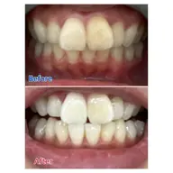 🉐1日1名様限定🉐ミニモ特割ホワイトニングコース🦷✨！