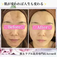 【9割以上が効果を実感】とにかく迷ったらこれ!ハーブピーリングより優しいミネラルイオンピーリング&肌細胞活性化ロウパック