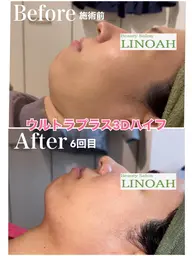 【小顔/たるみ】 ✨メスを使わないウルトラプラス３Dリフトアップ✨全顔＋イオン導入１回　¥22800⇒¥11800