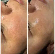 【韓国式肌管理】PDRNで水光肌/肌改善フェイシャル8,800円→7,700円