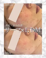 💆‍♀️最強たるみケア🔥サーマトリックス900shot＋水玉リフティングLDM🫧or選べる美容液アクアダーマ導入❕