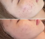 《ニキビケア》ハーブピーリング×炭酸パック♪ニキビ/ニキビ跡が気になる！痛み・DT・剥離なし♪低刺激！ハーブ全顔1g