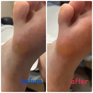 ✨フット✨夏先取りキャンペーン✨ジェルネイルと一緒の角質ケアでとってもお得❤️