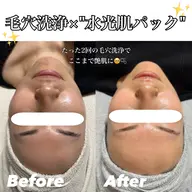 毛穴洗浄【艶&保湿・水光肌コース】(顔・首)