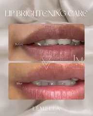 ｜ルメラ｜黒ずみ・メラニンケア｜リップモニター¥33000（通常価格¥44000）💋