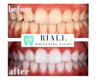 最高級プラチナセルフホワイトニング40分照射