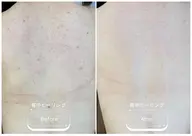 モニター募集🪡背中全体<7日間改善プログラム>剥離有ピーリング◎1週間で背中つるつる🫧ニキビ跡/ニキビ/色素沈着