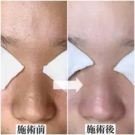 春の毛穴徹底改善コース✨デコルテマッサージ付き