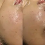 ハーブピーリング(顔)マッサージ無し