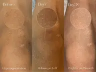 話題の最新黒ずみ除去【ローマピンク・ひじ又はひざ】 モニター募集中!!40%オフ