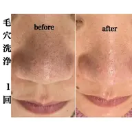 【鼻の毛穴洗浄×保湿】毛穴洗浄でイチゴ鼻払拭！1回￥2500/支払い現金