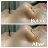 【鼻の黒ずみや毛穴にアプローチ】小顔矯正×毛穴洗浄