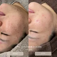 ✨new✨韓国ハーブピーリング🌿ニキビケア！剥離ありタイプ