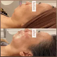 【フェイシャル人気NO.1】気になるお悩み解消✨小顔ハイパーナイフで最強リフトアップ🔥[心斎橋]