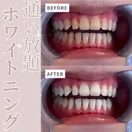 【定額★通い放題】セルフホワイトニング ¥11000/月
