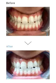 【医療】セルフホワイトニング¥3300(医療診療+¥17500)