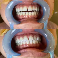 歯のセルフホワイトニング🪥 歯のビフォーアフターのお写真を撮らせてくれる方限定!!