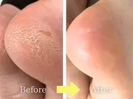 【フット】足裏角質ケア(タコ魚の目ケア)