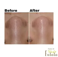 【3月✨ご新規様限定】毛穴の角栓ごっそり撃退コース ¥13,200→¥3,980