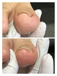 🔆3、4月ご新規様限定💎　　　　　　　　　　　　　　　　全巻き爪補正　¥5,500