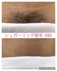 【40代以上の方限定⭐️半額キャンペーン】VIOシュガーリング脱毛