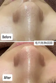 《ハイドロスプラッシュ水素毛穴洗浄✨》