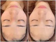 【針を使わない導入ケア】高濃度ビタミンC✨透明感のある肌印象へ