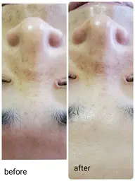 【毛穴引き締め】フェイシャル ハーブピーリング