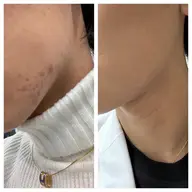 【都内最安値💆‍♀】ツルスベ肌💫小顔矯正×ハーブピーリングで垢抜け《毛穴/テカリ/ニキビ/肌荒れ/乾燥》