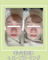 〈毛穴悩みに👃〉毛穴洗浄+ハーブピーリング(ダウンタイム&剥離なし)　70分14,000円
