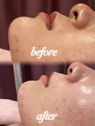 《月1ケア》顔シェービング＋パック