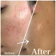 【お肌の悩みはこれで解決🌿サロン最上級ケア✨】毛穴洗浄＋セラピールor白玉ハーブ＋IPL光フォト＋肌悩み別マスク