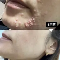 【初回半額】初めての方も安心♡ 繰り返すニキビ・毛穴に根本ケア🌿無添加ハーブピーリング『ハーバルシー』体験価格