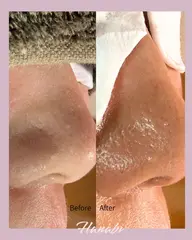 ✨4/30まで先着5名様限定✨【黒ずみ、皮脂詰まり解消】毛穴綺麗コース。毛穴汚れ一掃してモチベーション上げませんか？