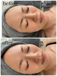 【韓国で話題のスペシャルケア】ララピール+LDM水玉リフティング