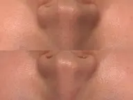 残り1名【毛穴×くすみ改善】韓国肌管理♪毛穴洗浄ハイドラ＆剥離なしハーブピーリング🌿¥28,000→¥11,500