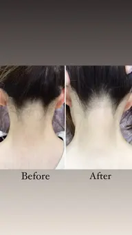 うなじ美肌脱毛💎