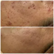 📍平日10-15時限定📍しつこいニキビ/繰り返すニキビ痕/毛穴/黒ずみ/天然温泉HOTパックつき♨️✨