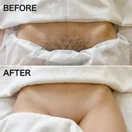 【結果重視！】痛みの少ないVIO脱毛　¥3,000