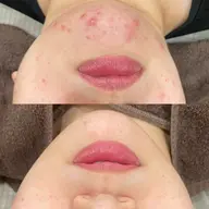 【平日のみ】背中剥離ありハーブピーリング🌿