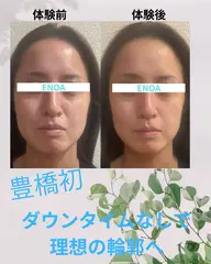 豊橋初✨溶解美容液｢レットショット｣2cc¥20000→¥11000首コルギ➕ドライヘッドスパ付