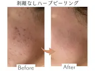 【リピート】剥離なし✨ハーブピーリング🌿🇰🇷